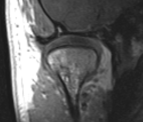 MRI image of TMJ